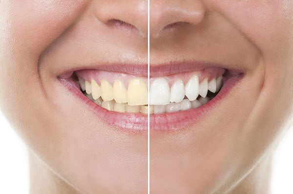 How Can You Whiten Your Teeth Safely at Home